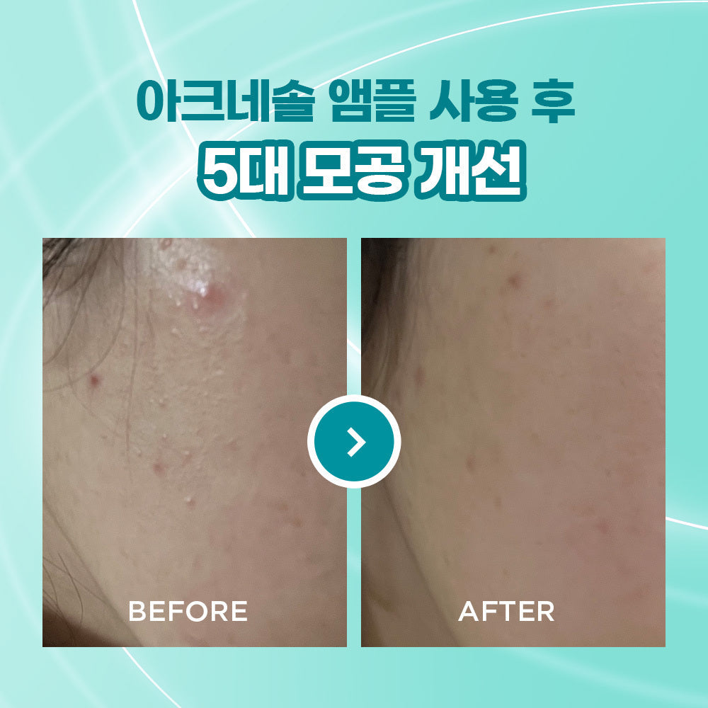 [Athe] Ate Acnesol Programming Ampoule Duo Project